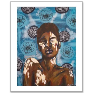 'The Beauty of Vitiligo', Isobel Lomax. Fine art print.